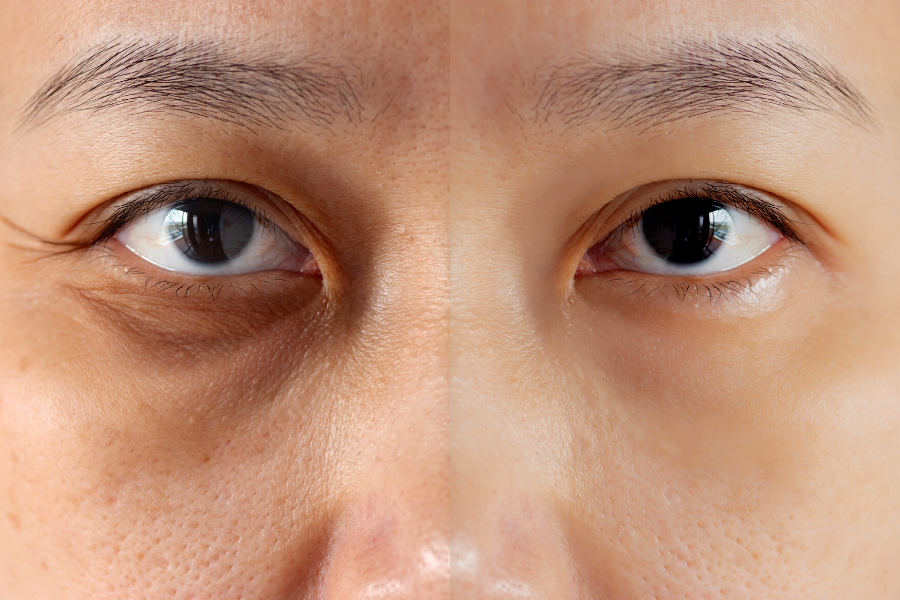 Instant Refresh The Magic of UnderEye Filler Explained